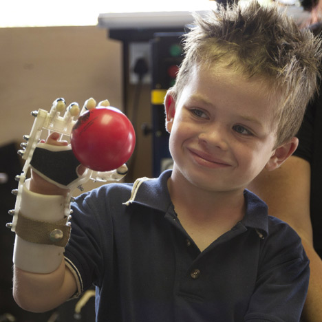 3D-printed Robohand helps children born without fingers