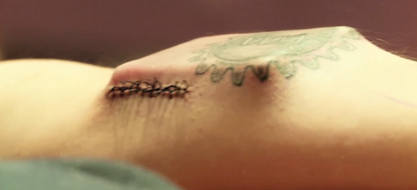 DIY Cyborg implants body tracking device under his skin