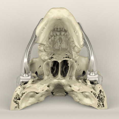 Custom-fit 3D-printed medical implant for bone reconstruction by Sebastiaan Deviaene