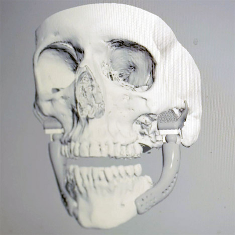 Custom-fit 3D-printed medical implant for bone reconstruction by Sebastiaan Deviaene